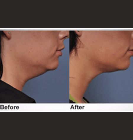 Before and after HIFU treatment results showing double chin reduction and neck tightening