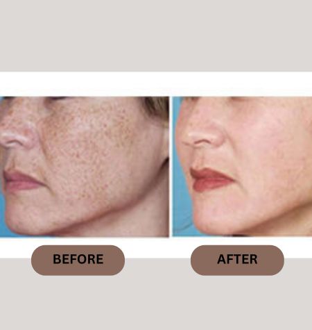 Before and after HIFU treatment results showing facial skin rejuvenation and reduction in pigmentation