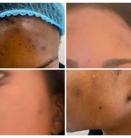 Before and after comparison showing improvements in hyperpigmentation on facial skin