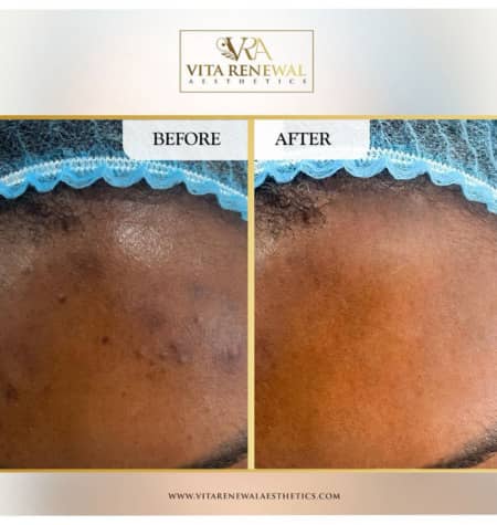 Before and after results of hyperpigmentation treatment showing improved skin tone