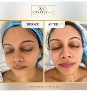 Before and after results of Mesotherapy treatment showing improved skin hydration and texture