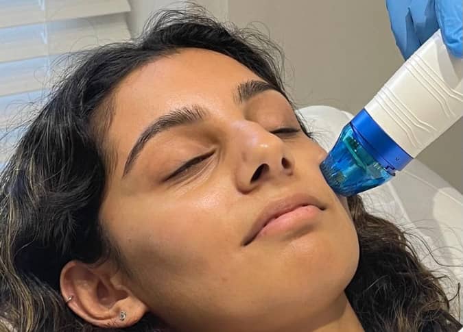 Woman receiving a Fractional RF (Radiofrequency) treatment on her face with a specialized device