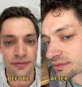 Results of RF Microneedling on a man's facial appearance