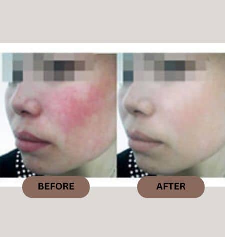 Before and after HIFU facelift with reduced skin inflammation and more even skin tone