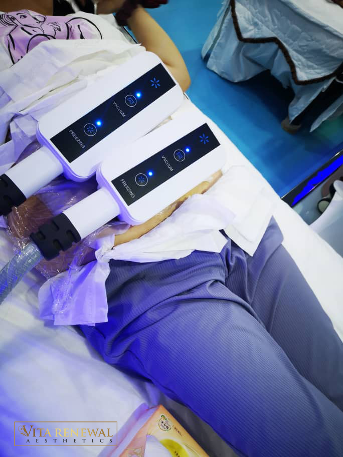 Cryolipolysis fat freezing treatment in Knightsbridge London