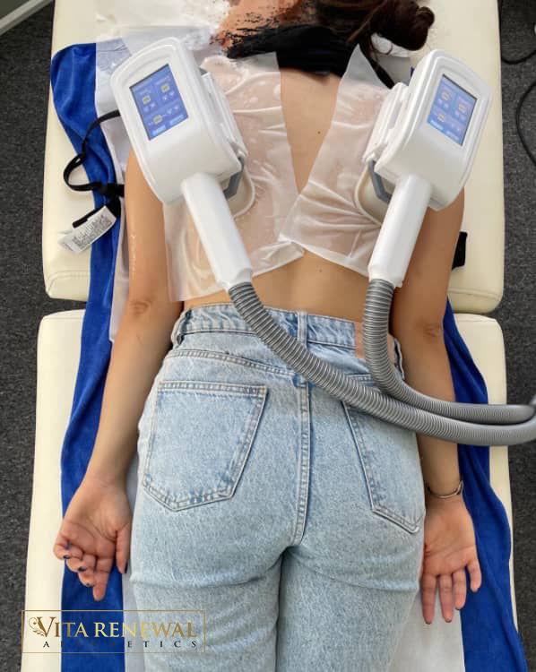 Cryolipolysis fat freezing treatment in Knightsbridge London